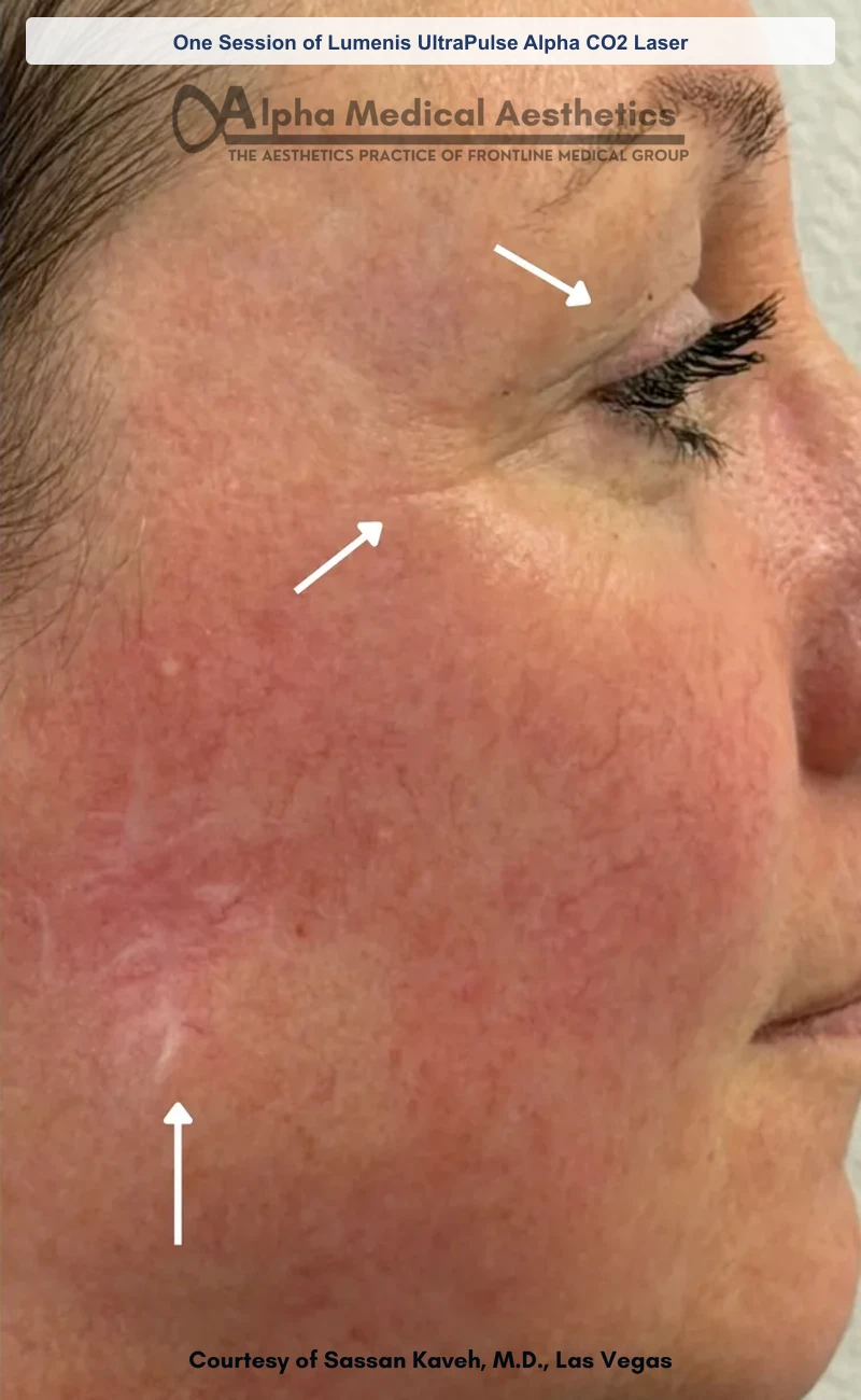 One Session of Lumenis UltraPulse Alpha CO2 Laser before and after in Las Vegas by Dr. Sassan Kaveh (After)