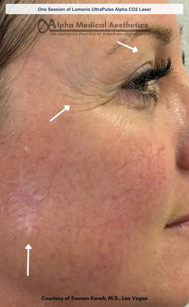 One Session of Lumenis UltraPulse Alpha CO2 Laser before and after in Las Vegas by Dr. Sassan Kaveh (Before)