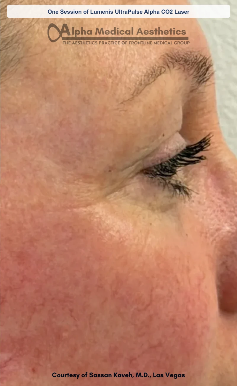 One Session of Lumenis UltraPulse Alpha CO2 Laser before and after in Las Vegas by Dr. Sassan Kaveh (After)