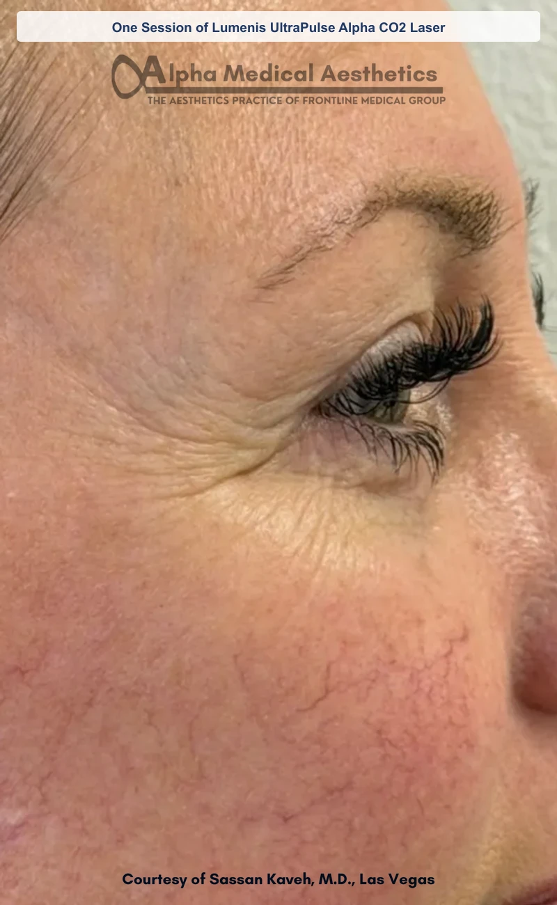 One Session of Lumenis UltraPulse Alpha CO2 Laser before and after in Las Vegas by Dr. Sassan Kaveh (Before)