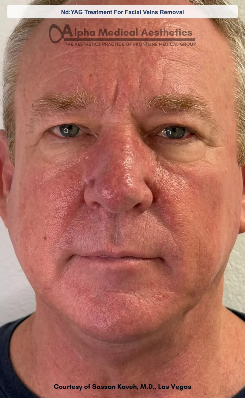 Nd:YAG Treatment For Facial Veins Removal before and after in Las Vegas by Dr. Sassan Kaveh (After)