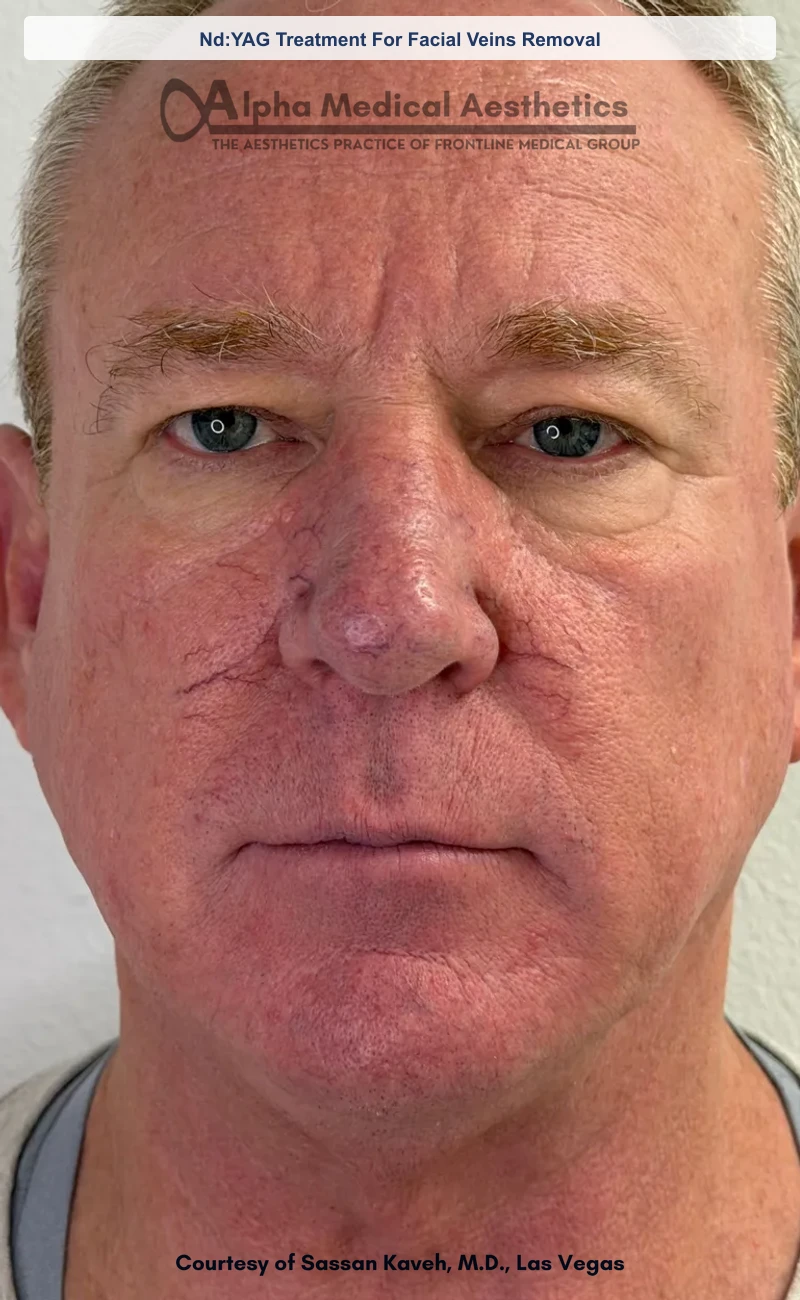 Nd:YAG Treatment For Facial Veins Removal before and after in Las Vegas by Dr. Sassan Kaveh (Before)