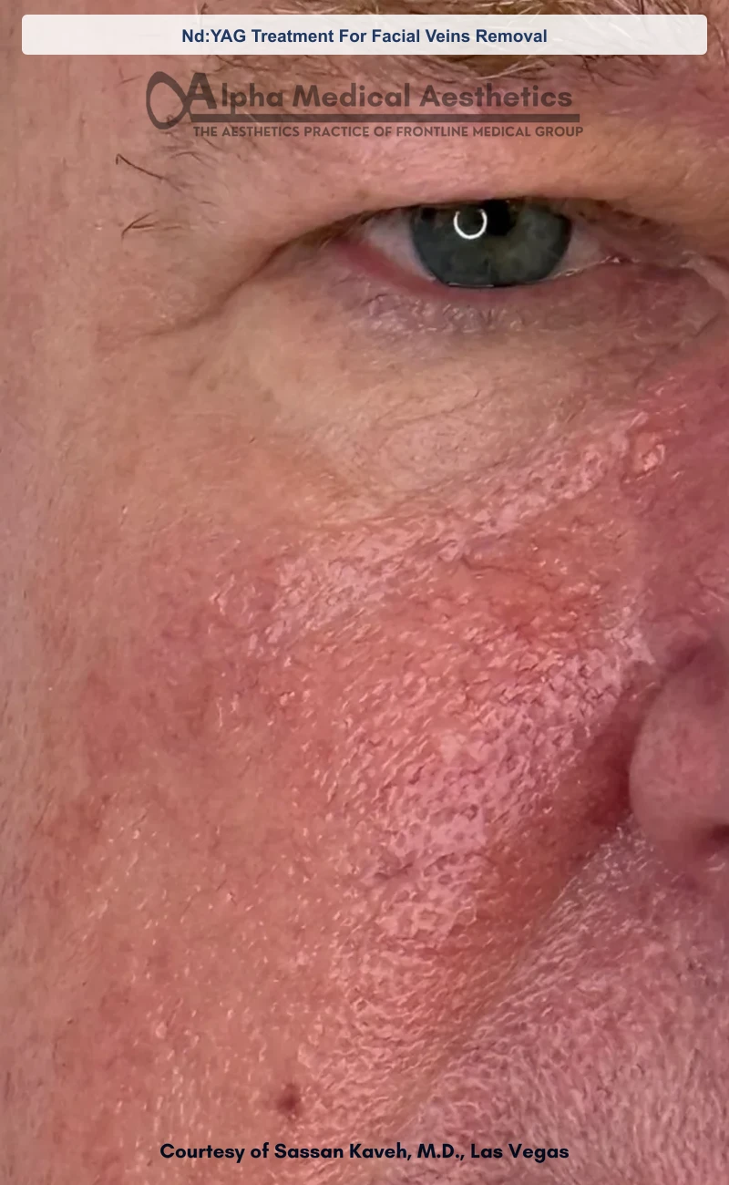 Nd:YAG Treatment For Facial Veins Removal before and after in Las Vegas by Dr. Sassan Kaveh (After)