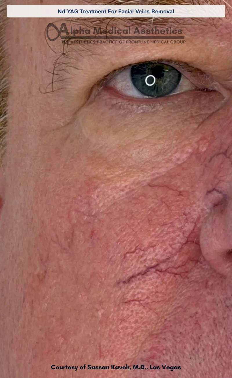Nd:YAG Treatment For Facial Veins Removal before and after in Las Vegas by Dr. Sassan Kaveh (Before)