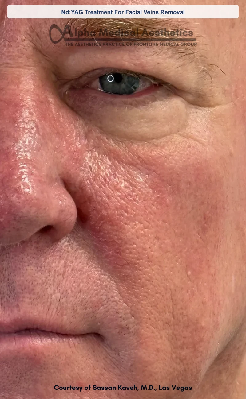 Nd:YAG Treatment For Facial Veins Removal before and after in Las Vegas by Dr. Sassan Kaveh (After)