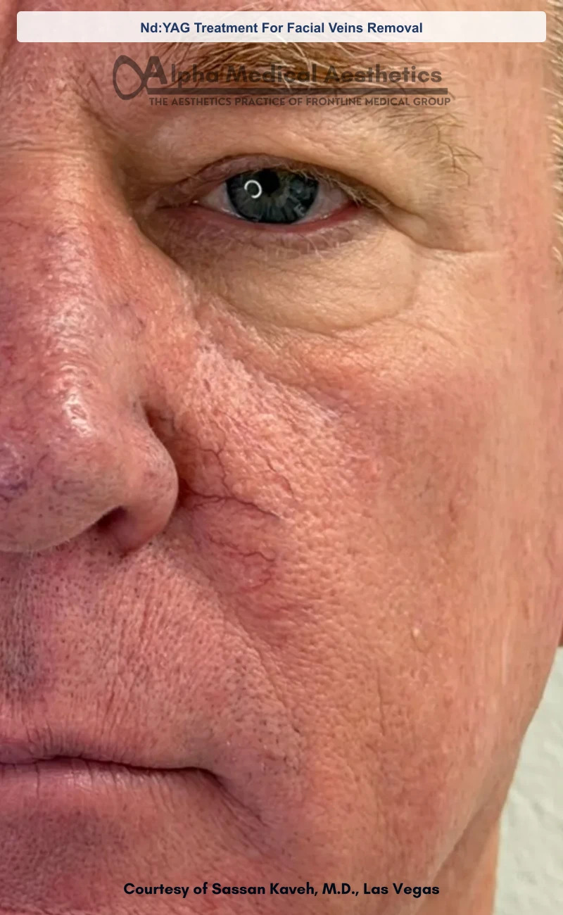 Nd:YAG Treatment For Facial Veins Removal before and after in Las Vegas by Dr. Sassan Kaveh (Before)