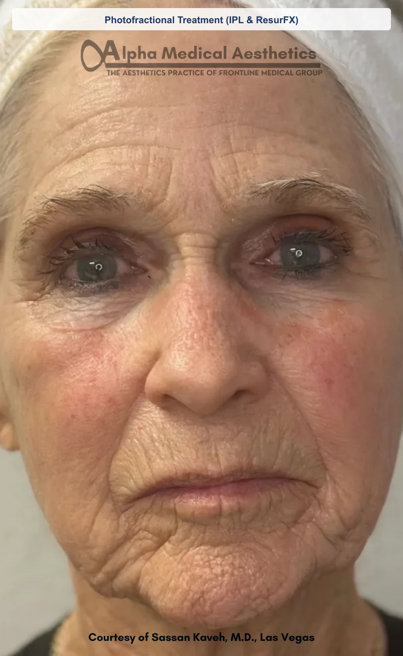 Photofractional Treatment (IPL & ResurFX) before and after in Las Vegas by Dr. Sassan Kaveh (After)
