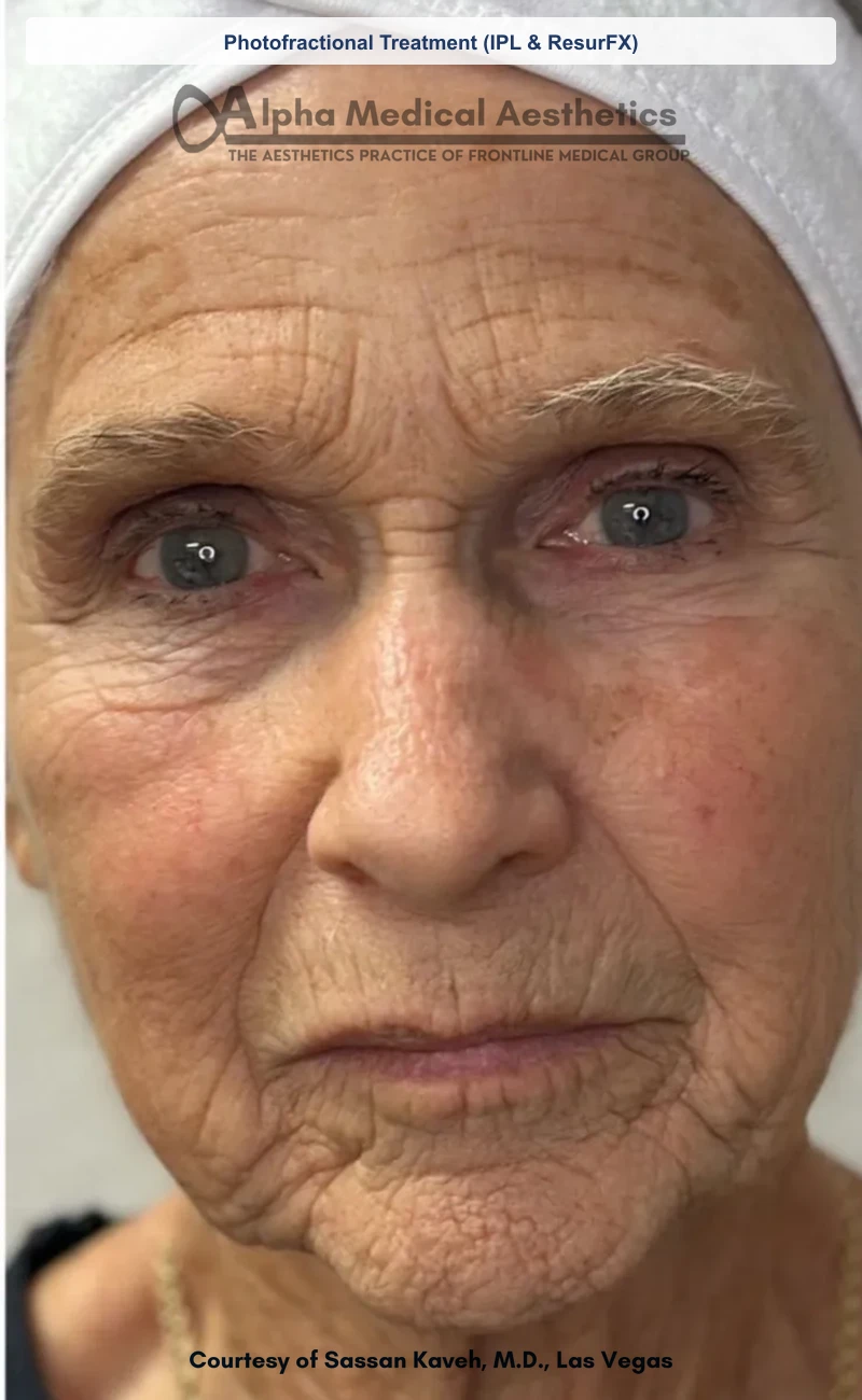 Photofractional Treatment (IPL & ResurFX) before and after in Las Vegas by Dr. Sassan Kaveh (Before)
