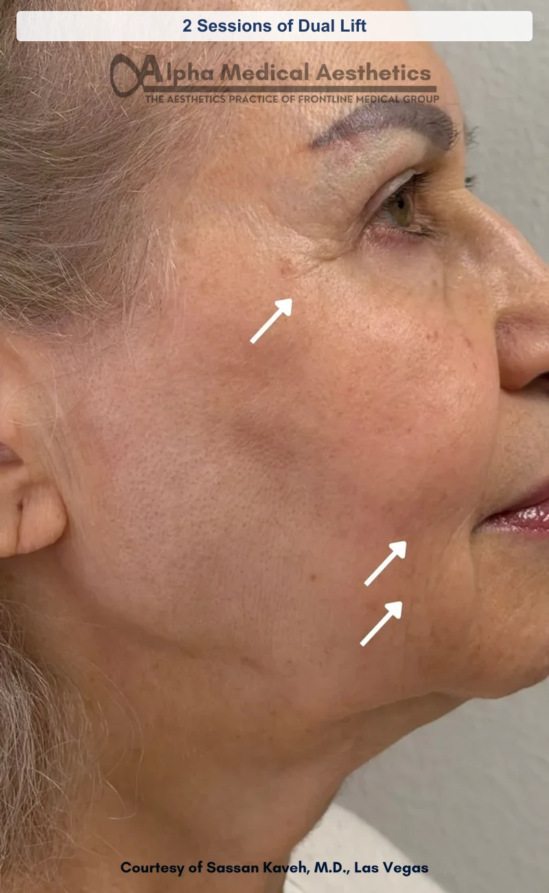 2 Sessions of Dual Lift before and after in Las Vegas by Dr. Sassan Kaveh (After)