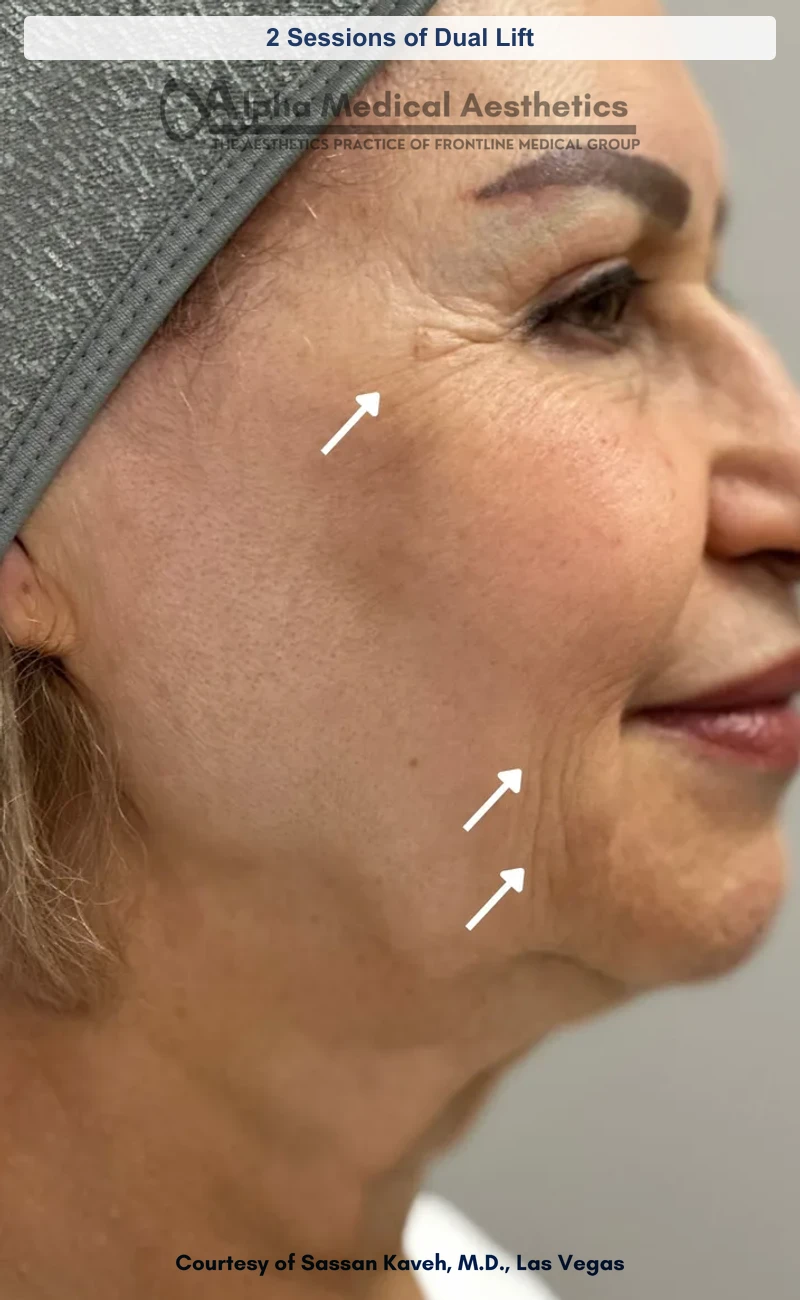 2 Sessions of Dual Lift before and after in Las Vegas by Dr. Sassan Kaveh (Before)