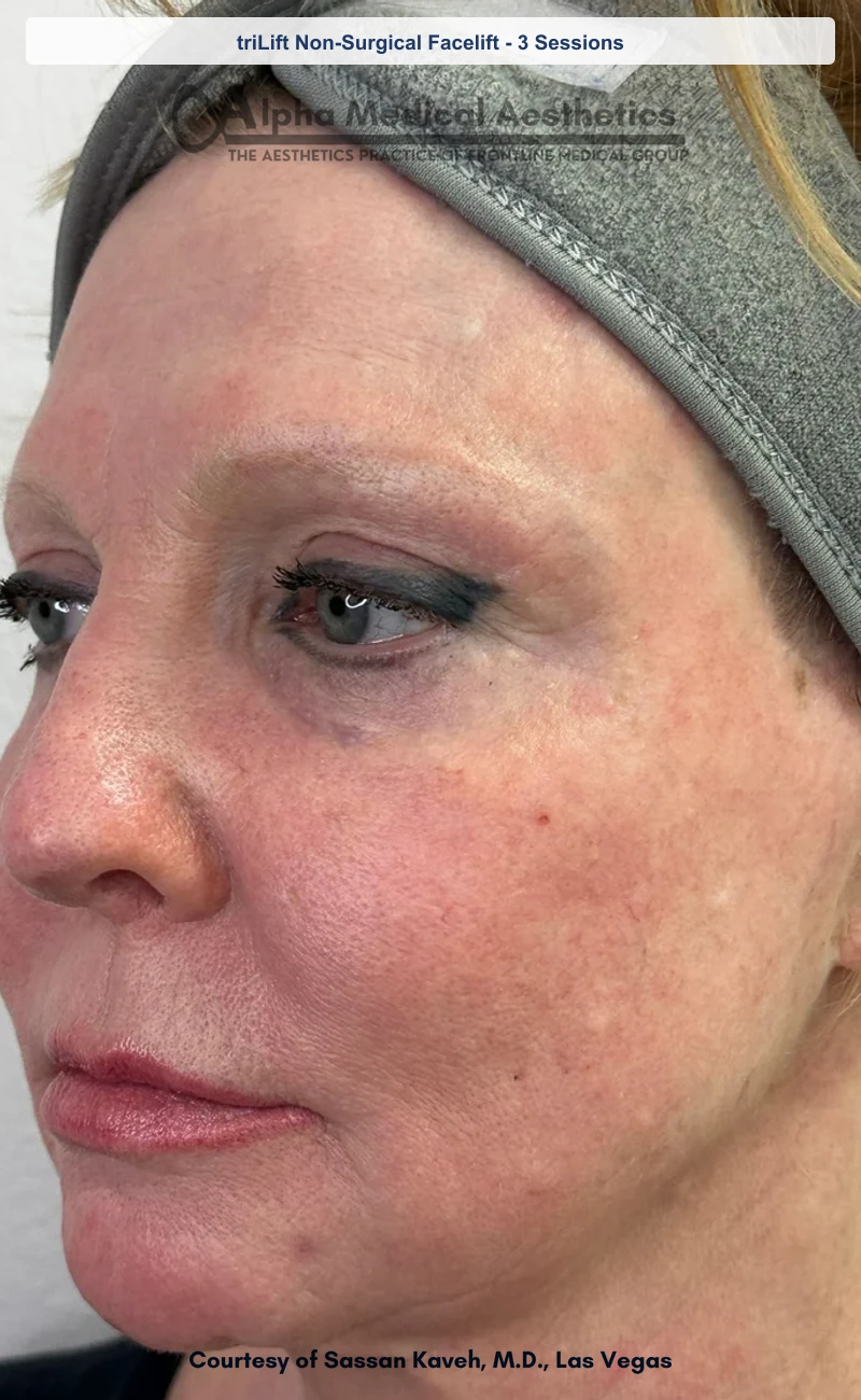 triLift Non-Surgical Facelift 5 Sessions before and after in Las Vegas by Dr. Sassan Kaveh (After)