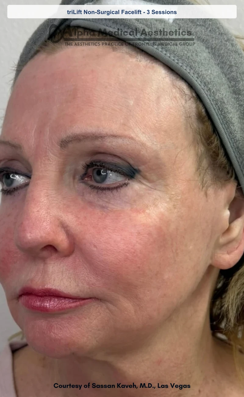triLift Non-Surgical Facelift 5 Sessions before and after in Las Vegas by Dr. Sassan Kaveh (Before)