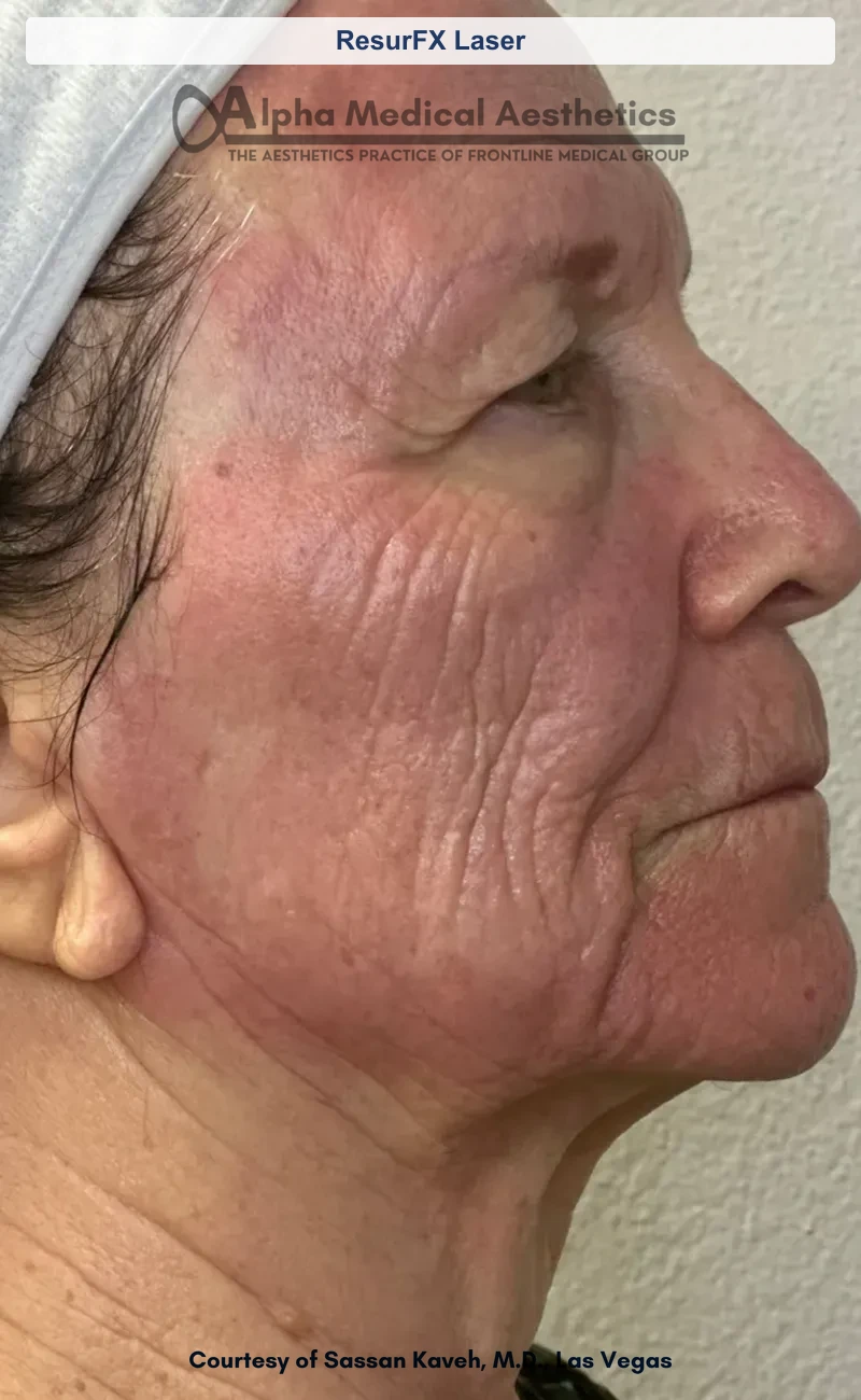 ResurFX non-ablative laser resurfacing before and after in Las Vegas - smoother texture, softened scars (ResurFX Laser) (After)