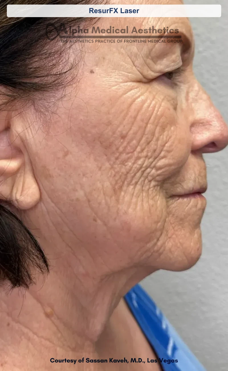 ResurFX non-ablative laser resurfacing before and after in Las Vegas - smoother texture, softened scars (ResurFX Laser) (Before)