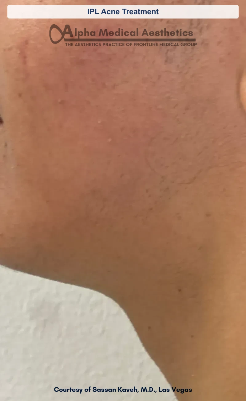 IPL acne treatment before and after in Las Vegas - clearer calmer skin with fewer breakouts (IPL Acne Treatment) (After)