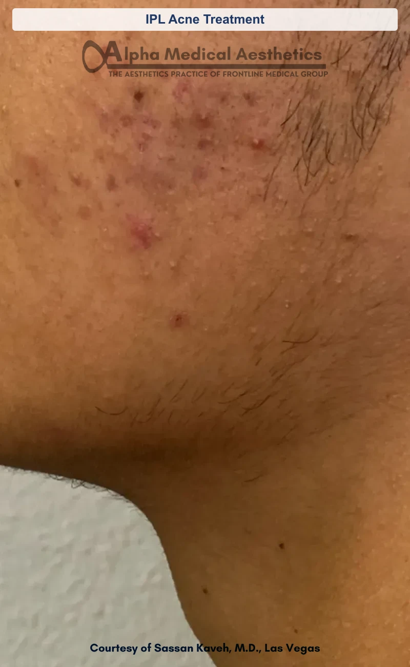 IPL acne treatment before and after in Las Vegas - clearer calmer skin with fewer breakouts (IPL Acne Treatment) (Before)