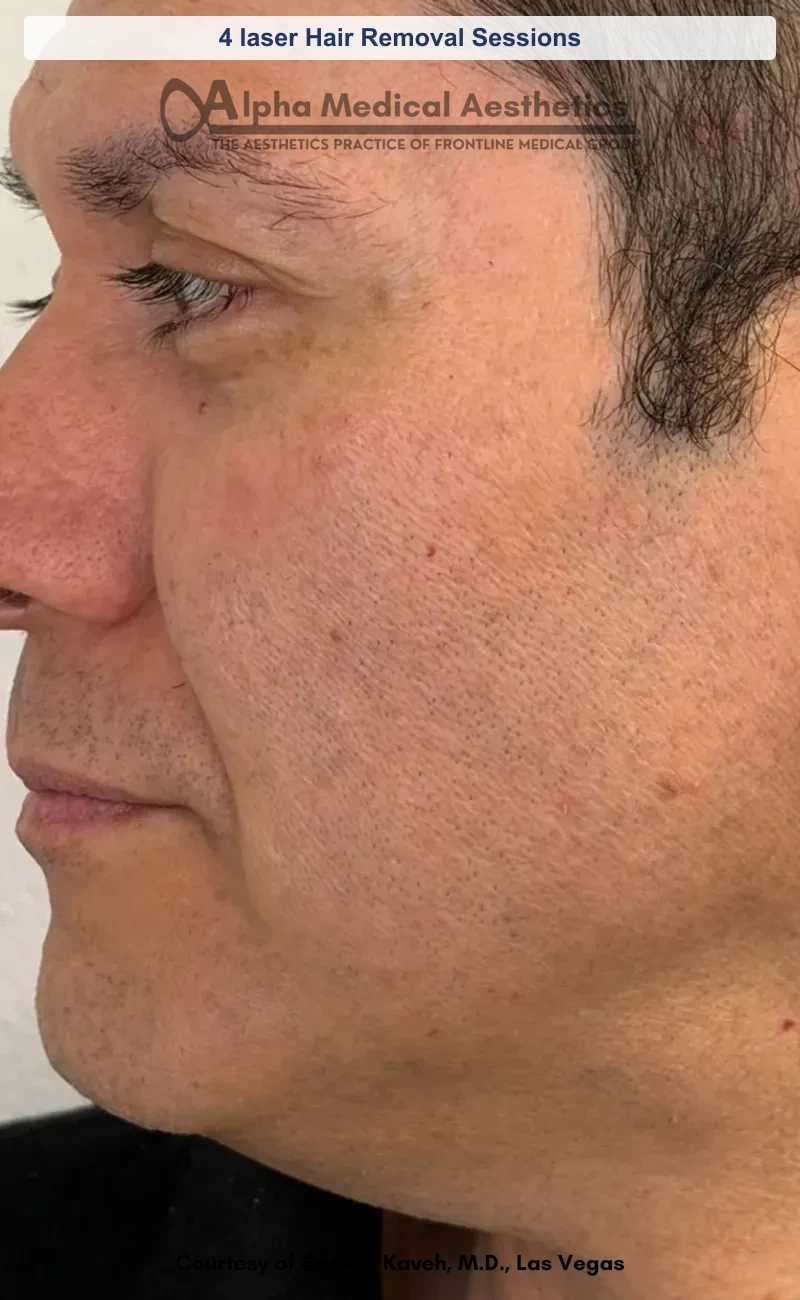 SplendorX laser hair removal before and after in Las Vegas - smoother hair-free skin (4 laser Hair Removal Sessions) (After)
