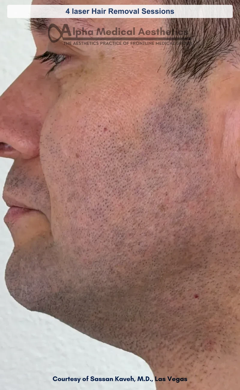 SplendorX laser hair removal before and after in Las Vegas - smoother hair-free skin (4 laser Hair Removal Sessions) (Before)