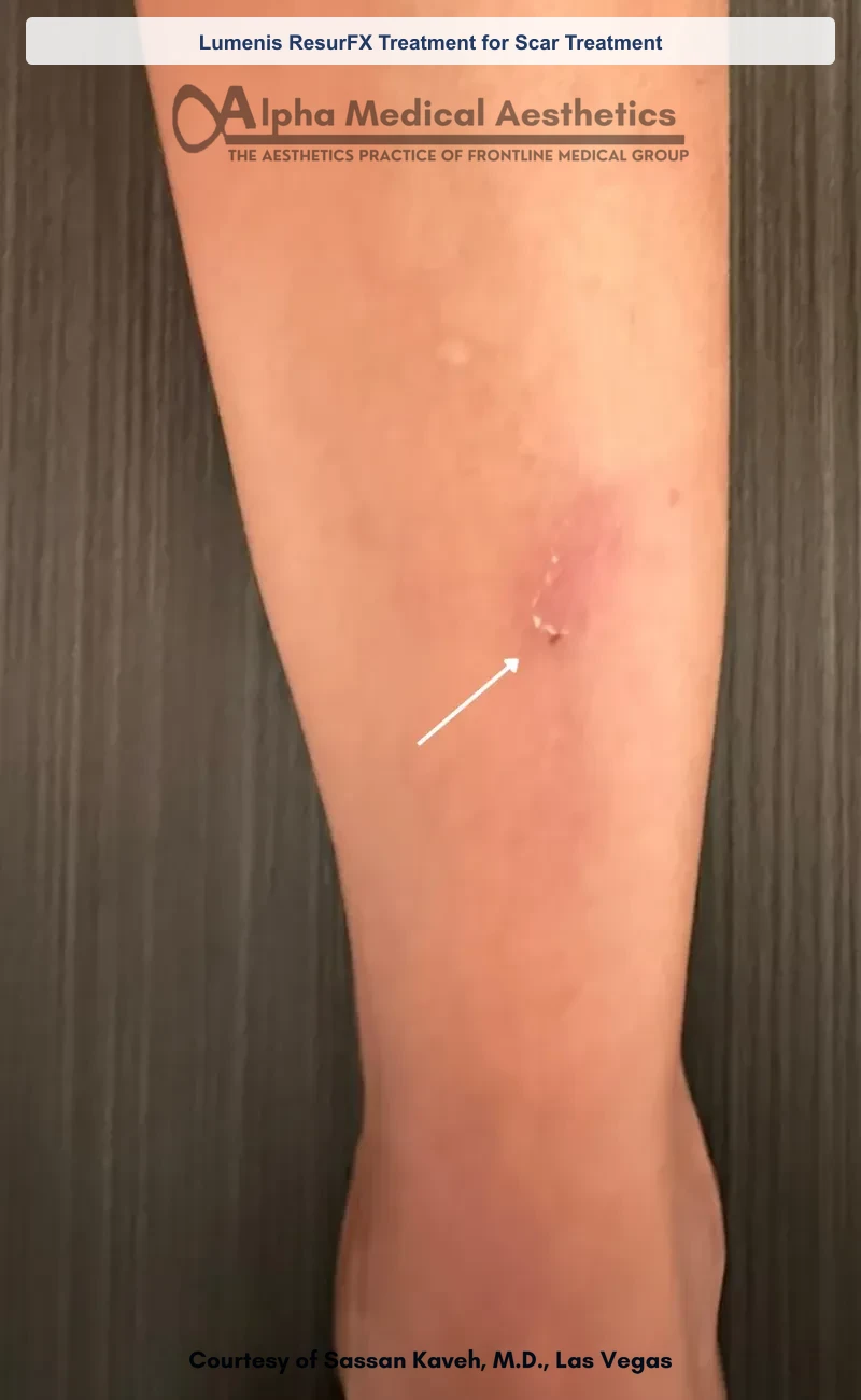 ResurFX non-ablative laser resurfacing before and after in Las Vegas - smoother texture, softened scars (Lumenis ResurFX Treatment for Scar Treatment) (After)