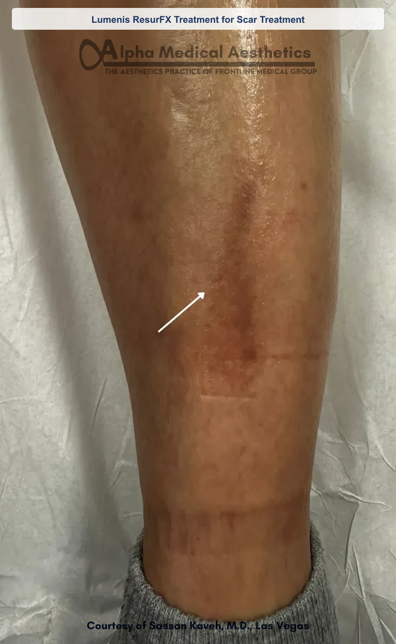 ResurFX non-ablative laser resurfacing before and after in Las Vegas - smoother texture, softened scars (Lumenis ResurFX Treatment for Scar Treatment) (Before)