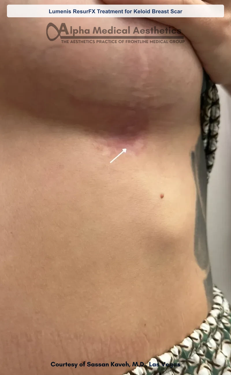 ResurFX non-ablative laser resurfacing before and after in Las Vegas - smoother texture, softened scars (Lumenis ResurFX Treatment for Keloid Breast Scar) (After)