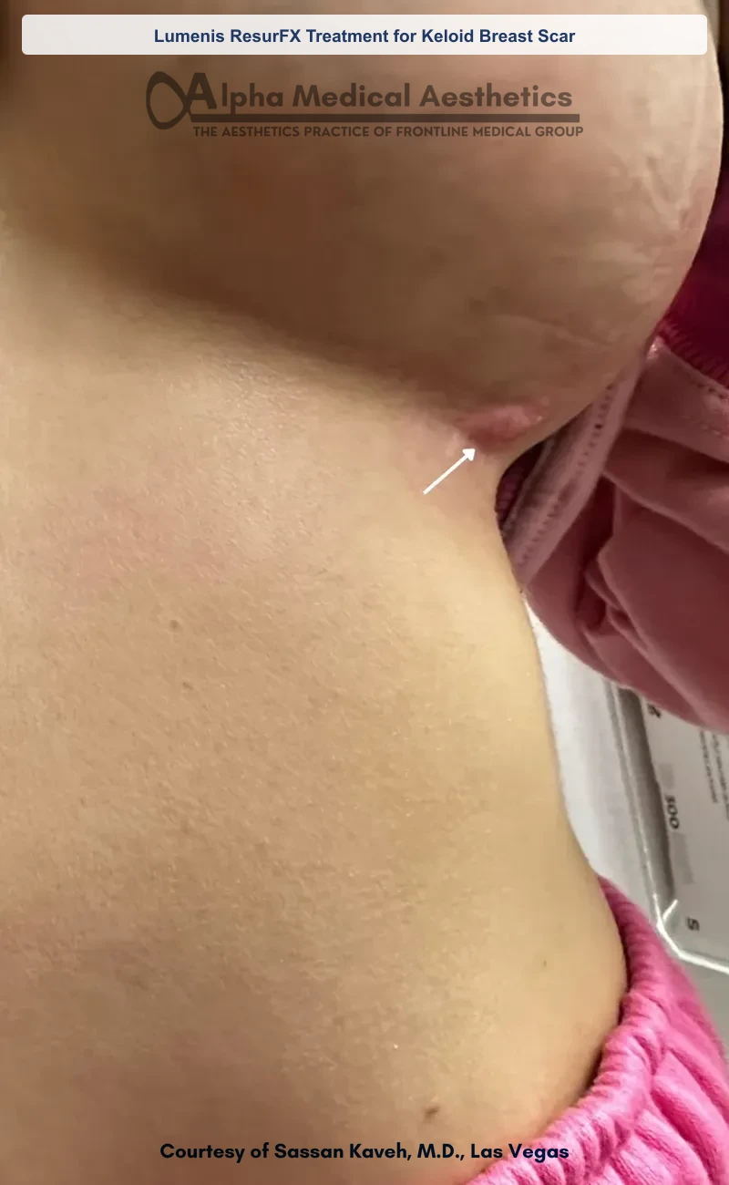 ResurFX non-ablative laser resurfacing before and after in Las Vegas - smoother texture, softened scars (Lumenis ResurFX Treatment for Keloid Breast Scar) (Before)