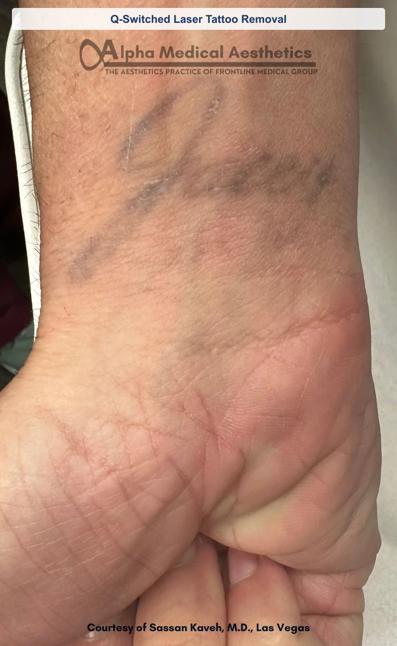 Q-Switched laser tattoo removal of a wrist script tattoo before and after in Las Vegas by Dr. Sassan Kaveh (After)