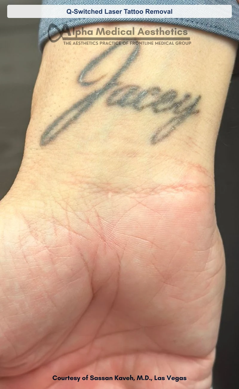 Q-Switched laser tattoo removal of a wrist script tattoo before and after in Las Vegas by Dr. Sassan Kaveh (Before)