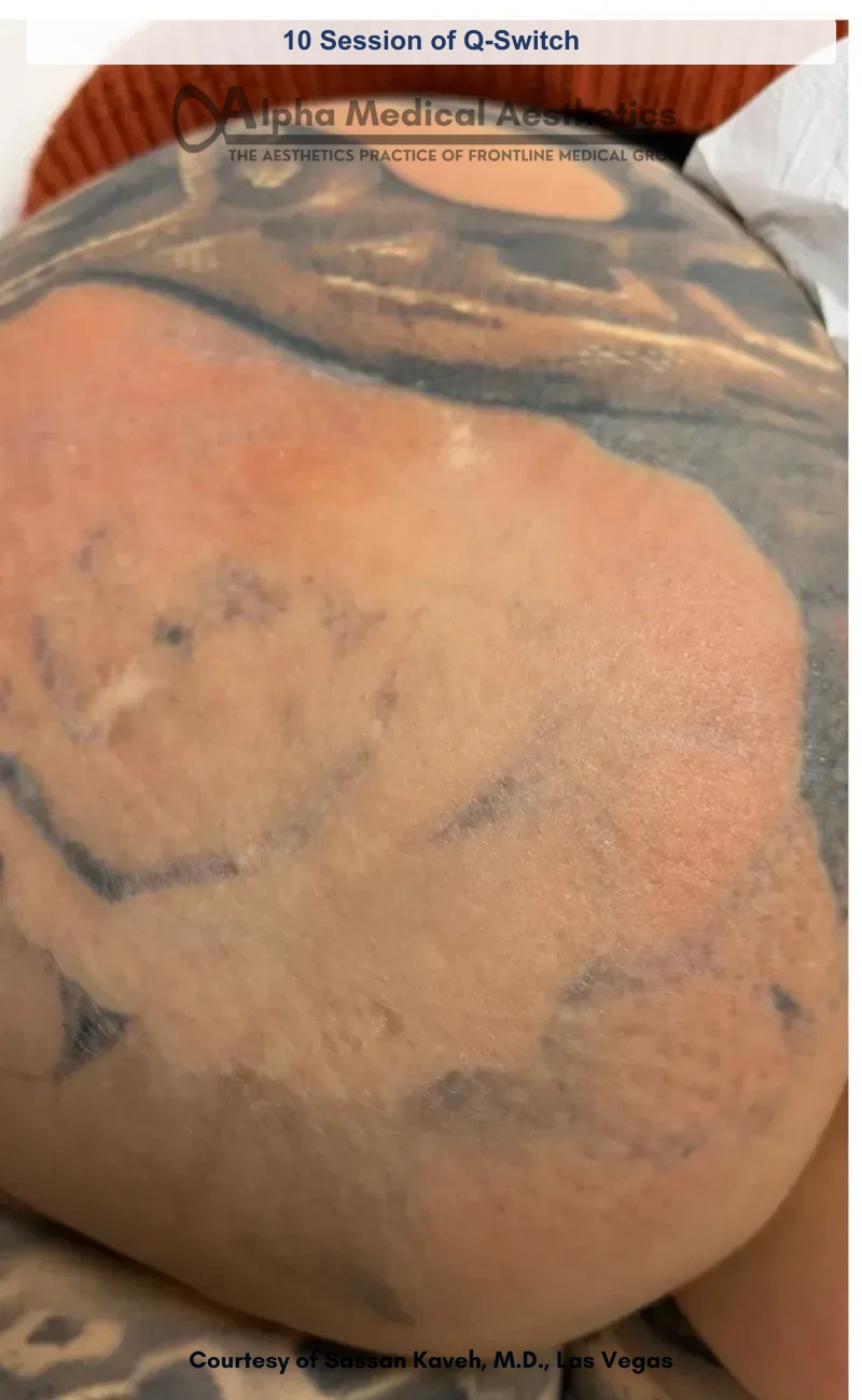 Q-switched laser tattoo removal before and after in Las Vegas - visibly faded ink after 10 sessions (After)