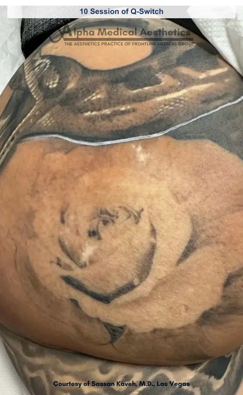 Q-switched laser tattoo removal before and after in Las Vegas - visibly faded ink after 10 sessions (Before)