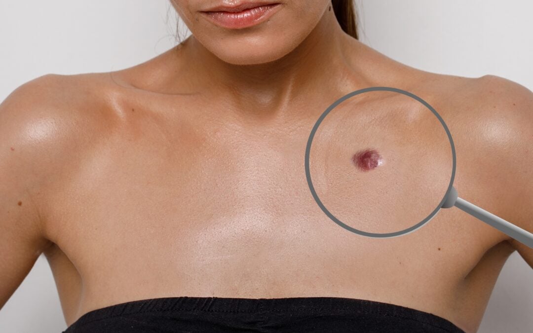 Quick Fixes Before Fall Events: Skin Tag and Sun Spot Removal in Las Vegas