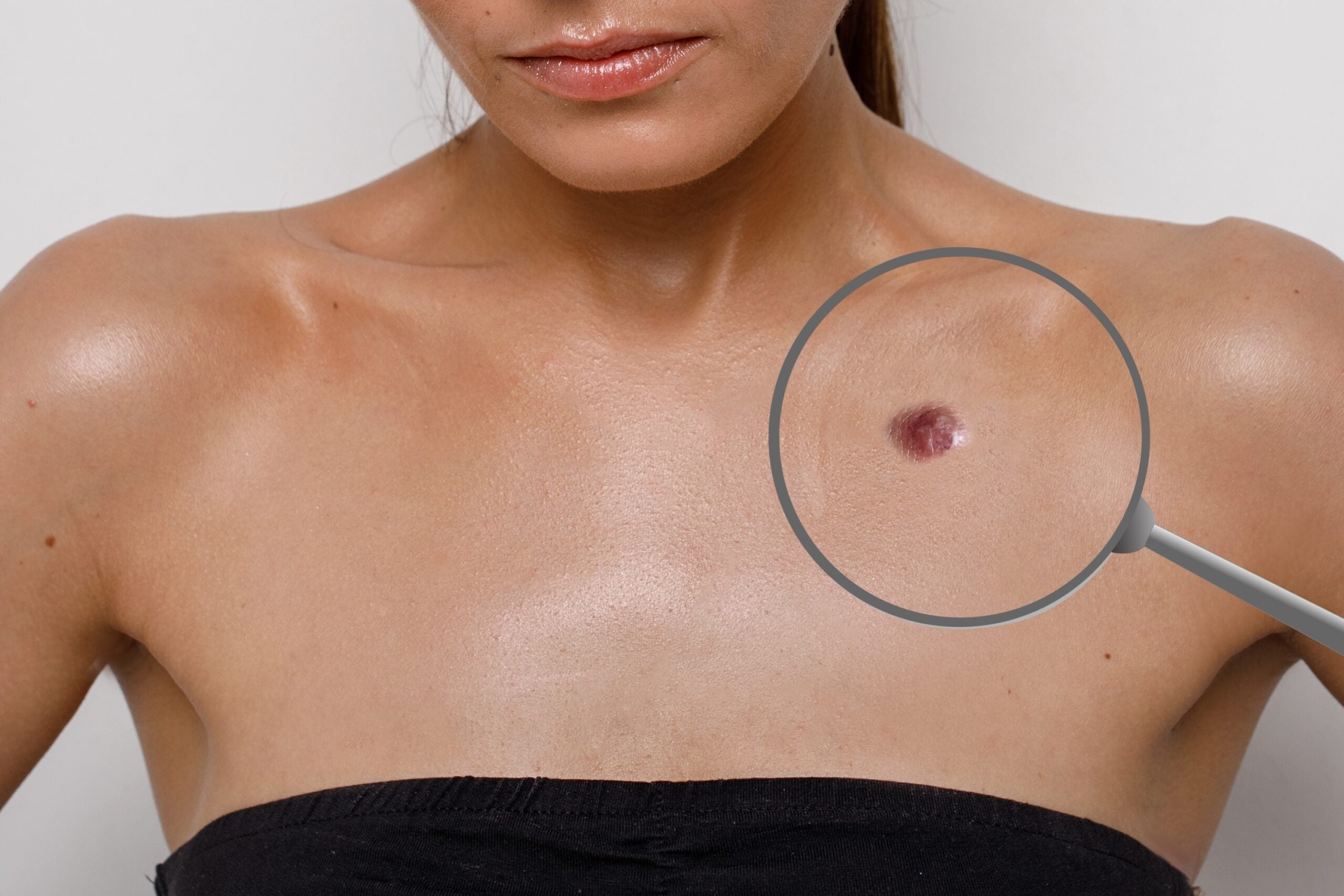 skin tag removal in Las Vegas