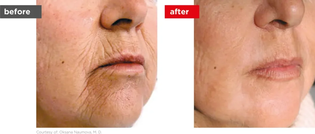 Fotona Er:YAG laser resurfacing before and after, perioral wrinkles
