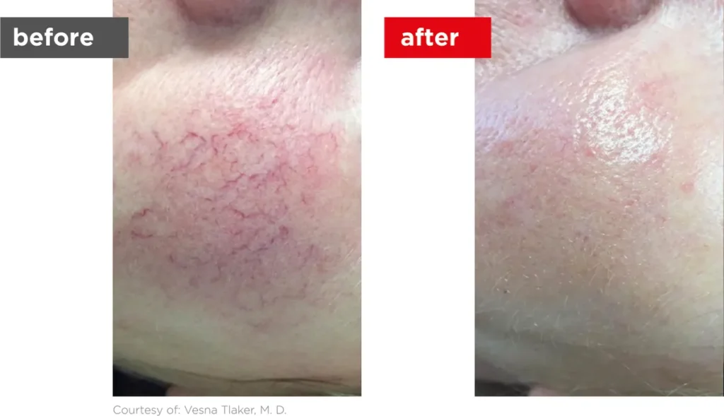 Facial broken capillaries before and after laser treatment