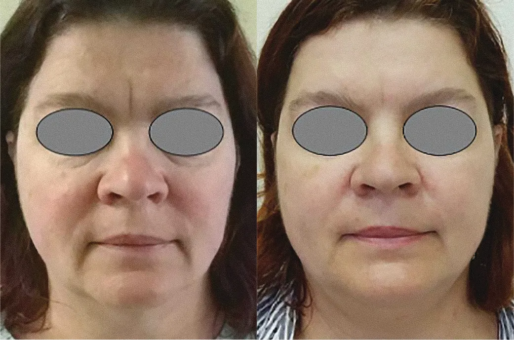 Fotona 4D laser facelift before and after, full face
