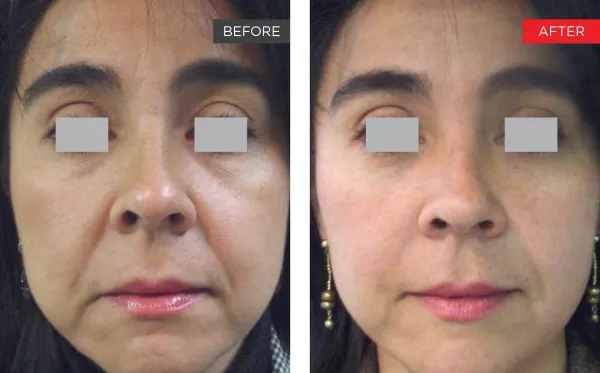 Fotona 4D non-surgical facelift before and after, midface and jawline