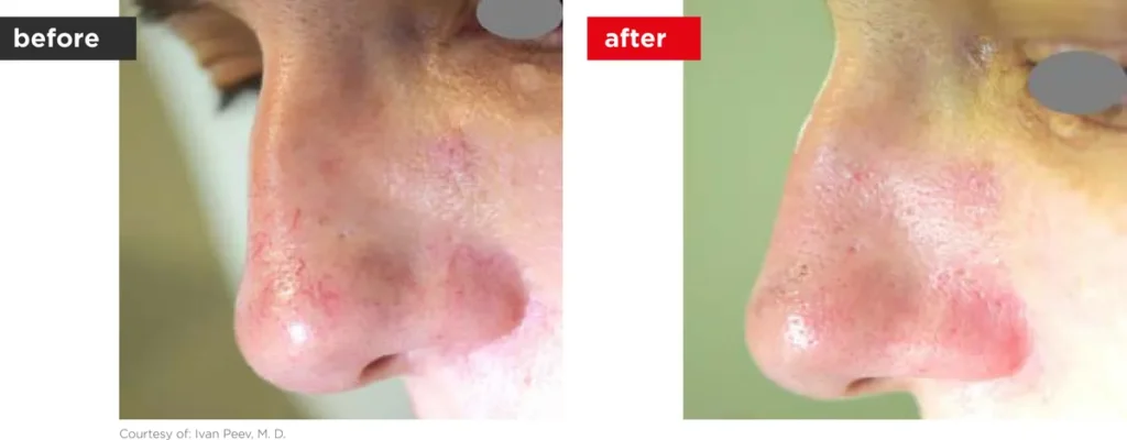 Redness and visible vessels on the nose before and after laser treatment
