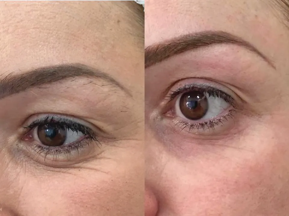 SmoothEye non-surgical eye lift before and after, smoother crow's feet