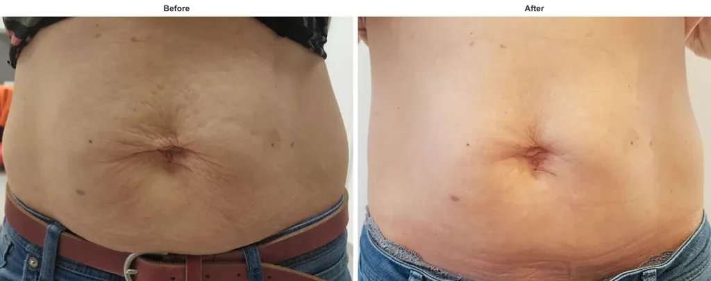TightSculpting abdomen before and after, reduced fat and tighter skin